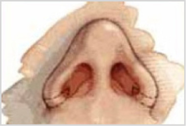 Rhinoplasty Procedure